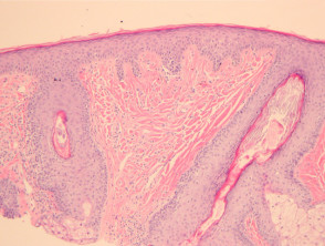 Angiofibroma pathology