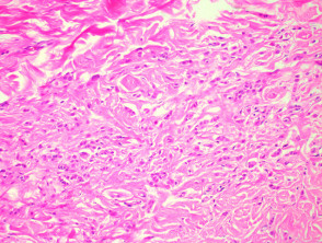 Angiomyofibroblastoma  pathology