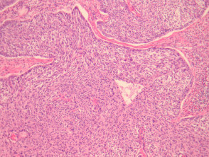 Malignant basomelanocytic tumour pathology