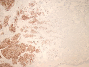 Malignant basomelanocytic tumour pathology