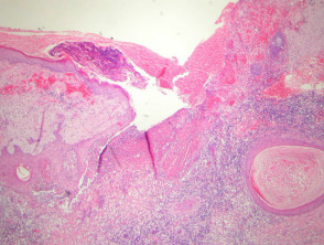 Blastomycosis-like pyoderma pathology