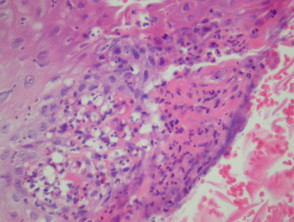 Blastomycosis-like pyoderma pathology