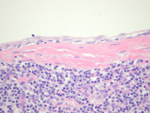 Branchial cleft cyst pathology