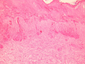 Calciphylaxis  pathology