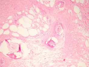 Calciphylaxis  pathology