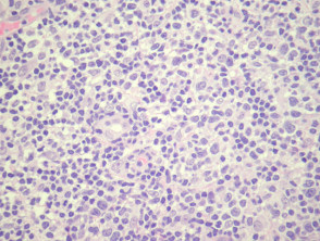 Cutaneous small–medium pleomorphic T-Cell lymphoma pathology
