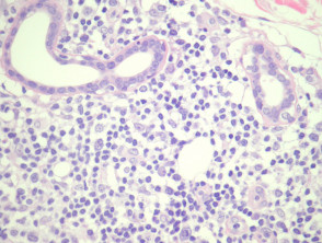 Cutaneous small–medium pleomorphic T-Cell lymphoma pathology