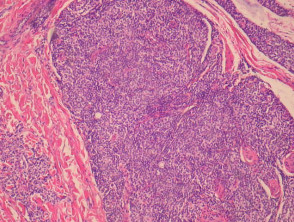 Indolent cutaneous CD8+ lymphoid proliferation pathology