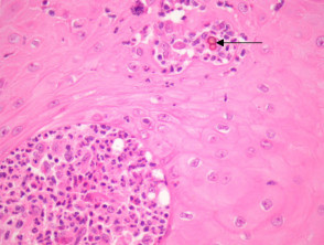 Chromoblastomycosis pathology