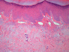  Collagenous and elastotic marginal plaques of the hands (CEMPH) pathology