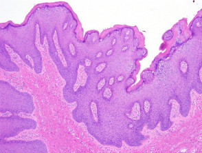 Condyloma acuminatum  pathology