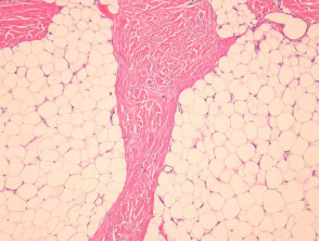 Fibroblastic connective tissue naevus pathology