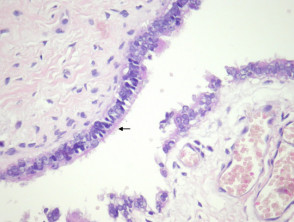 Cutaneous ciliated cyst   pathology