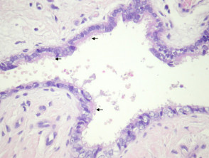 Cutaneous ciliated cyst   pathology