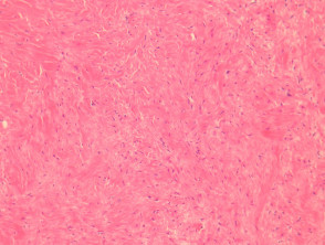 Lipoma pathology