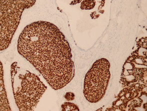 Endocrine mucin–producing sweat gland carcinoma pathology