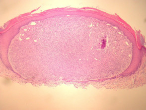 Epithelioid histiocytoma pathology