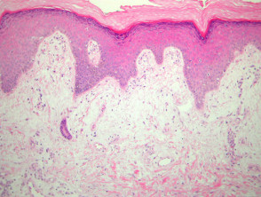 Erysipelas  pathology