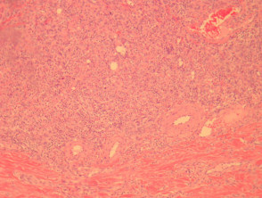 Erysipelas  pathology