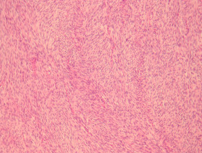 Fibrosarcoma pathology