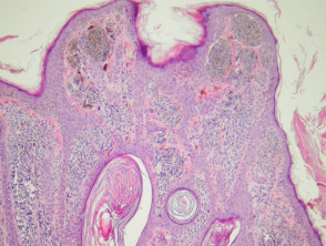 Melanocytic naevus pathology: compound naevus
