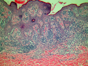 Melanocytic naevus pathology: compound naevus