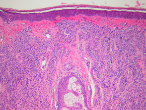 Melanocytic naevus pathology: dermal naevus