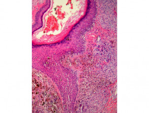 Melanocytic naevus pathology: genital naevus