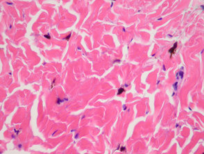 Common blue naevus pathology
