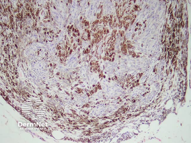 Histopathology of a cellular blue naevus - cells may be round oval or fusiform