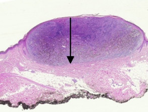Melanoma pathology: Breslow thickness of lentiginous melanoma