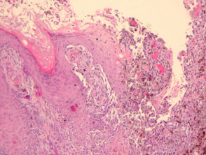 Melanoma pathology: ulceration
