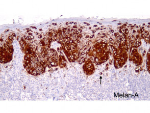 Melanoma in situ - Melan-A staining