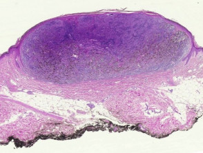 Melanoma pathology: nodular melanoma