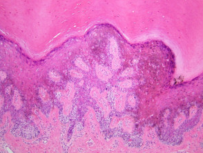 Melanoma pathology: Acral lentiginous melanoma