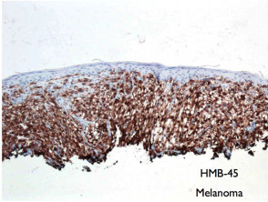 Melanocytic immunostain – HMB-45