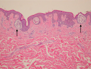 Melanocytic naevus pathology: junctional naevus