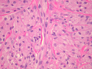 Granular cell tumour pathology
