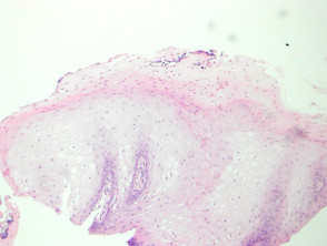 Oral hairy leukoplakia pathology