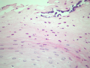 Oral hairy leukoplakia pathology