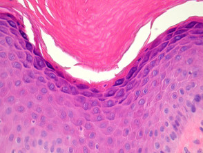 Inflammatory Linear Verrucous Epidermal Naevus pathology