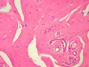 Lipoid proteinosis pathology