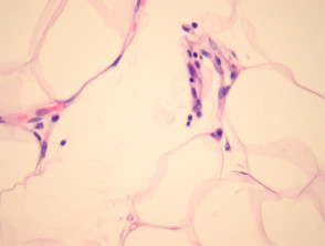 Lipoma pathology