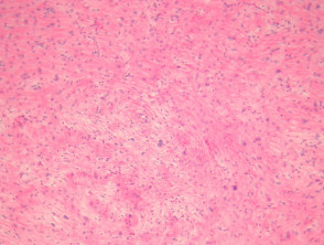 Sclerosing variant of well-differentiated liposarcoma pathology