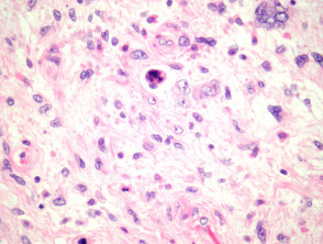 Pleomorphic liposarcoma pathology