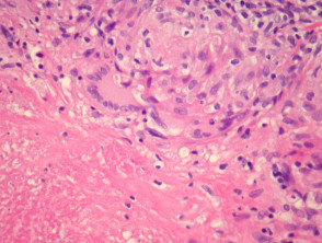 Lupus miliaris disseminatus faciei pathology
