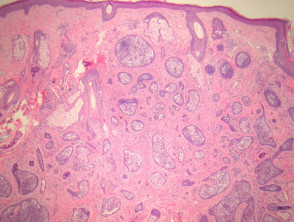 Pathology of cutaneous lymphadenoma
