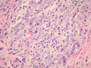 Lymphoepithelioma-like carcinoma pathology