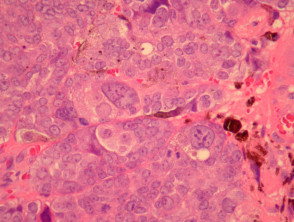 Melanocytic matricoma pathology