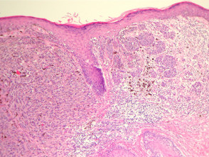 Melanoma pathology: superficial spreading melanoma, vertical growth phase